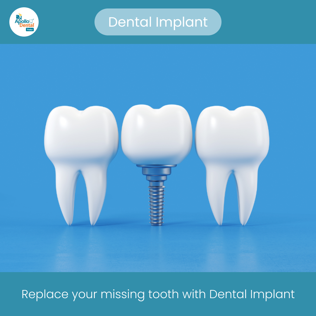 Missing tooth? Opt for Dental Implant